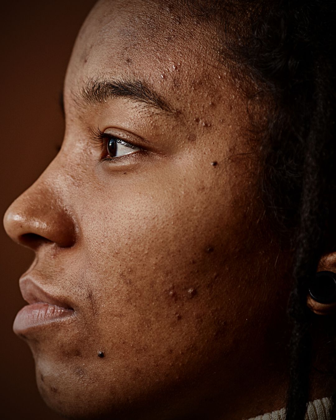 What causes dark spots on the skin?