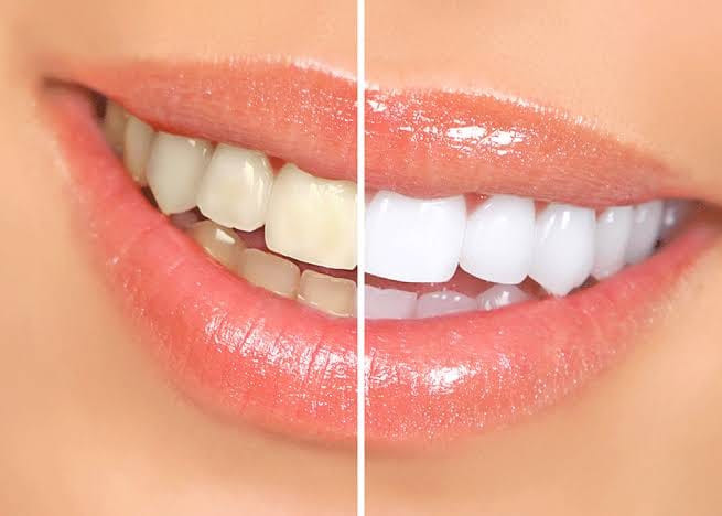 Teeth Whitening Kits
