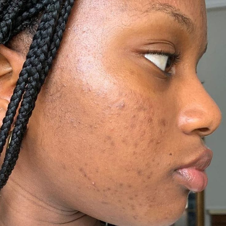 Hyperpigmentation/Dark Spots