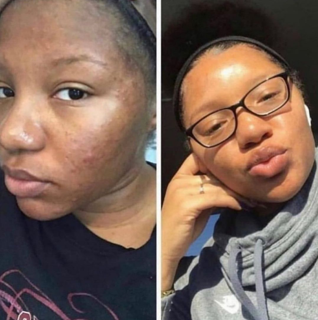 PIMPLES/ANCE SPOT REMOVAL COMPLETE SET image